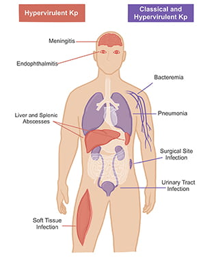 Graphic of human body highlighting anatomical sites of documented Kp infection.